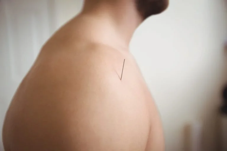 Aiguille d'acupuncture sur l'épaule